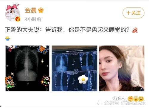 脊柱侧弯的明星网红,勇敢面对，绽放光芒